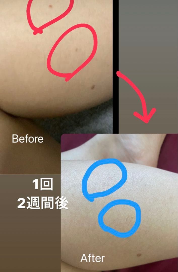 プラズマフェイシャルマシン