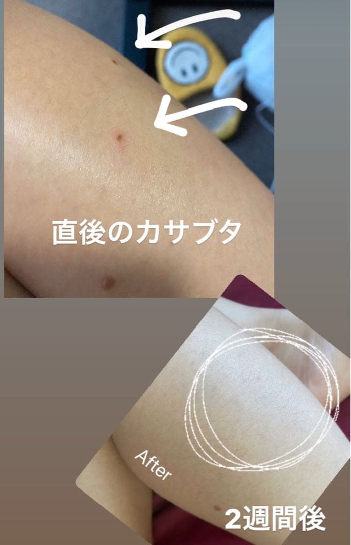 プラズマフェイシャルマシン