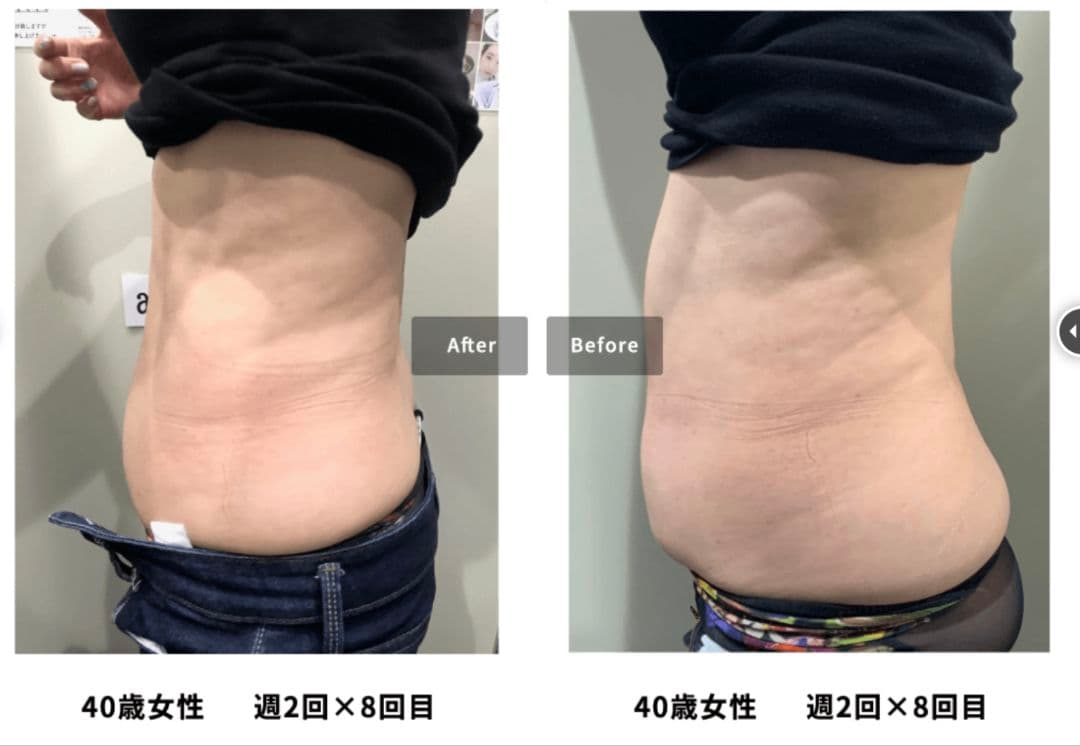 BeatOne 美容機器 ハンドピース付き