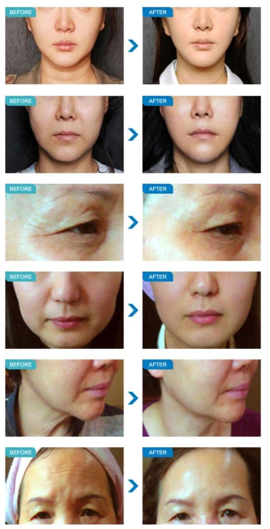 HICSU リフトアップ　業務用美容機器　たるみ　しわ　Vmax 韓国　ハイフ