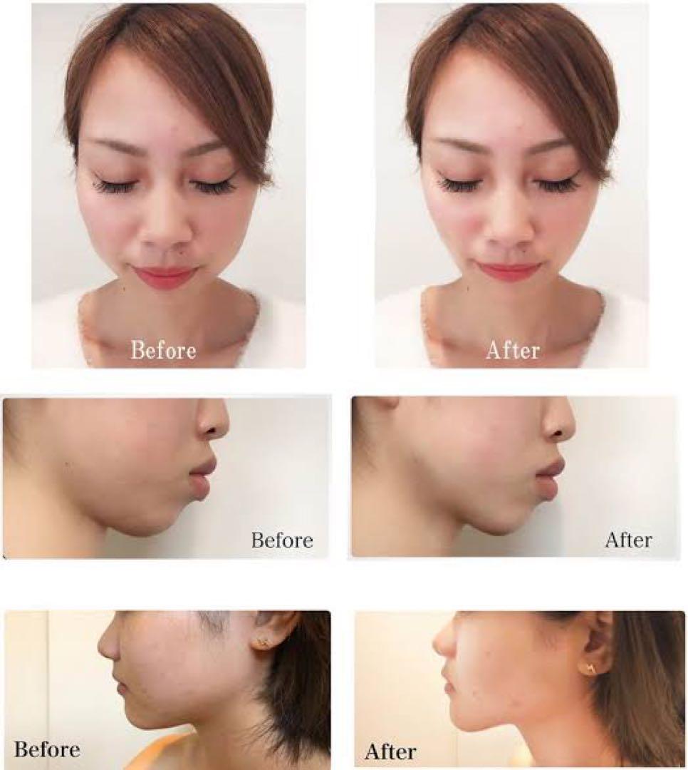 HICSU リフトアップ　業務用美容機器　たるみ　しわ　Vmax 韓国　ハイフ