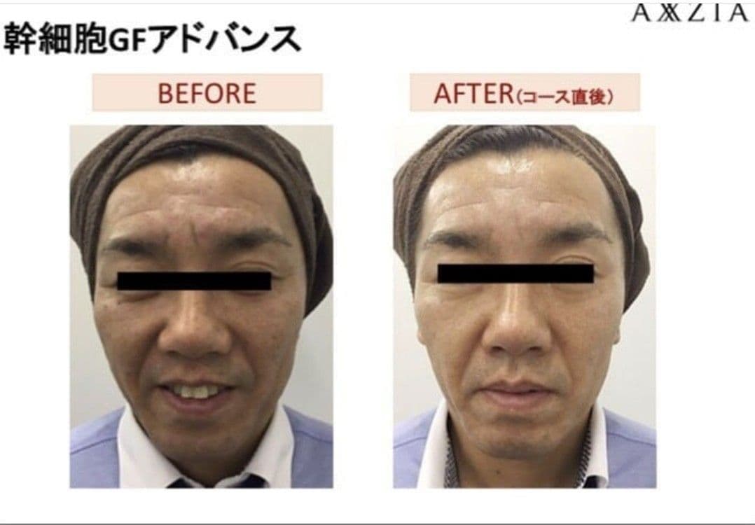 【本物】アクシージア☆GFチャージアドバンス☆美容液導入美肌艶肌水光注射エステ