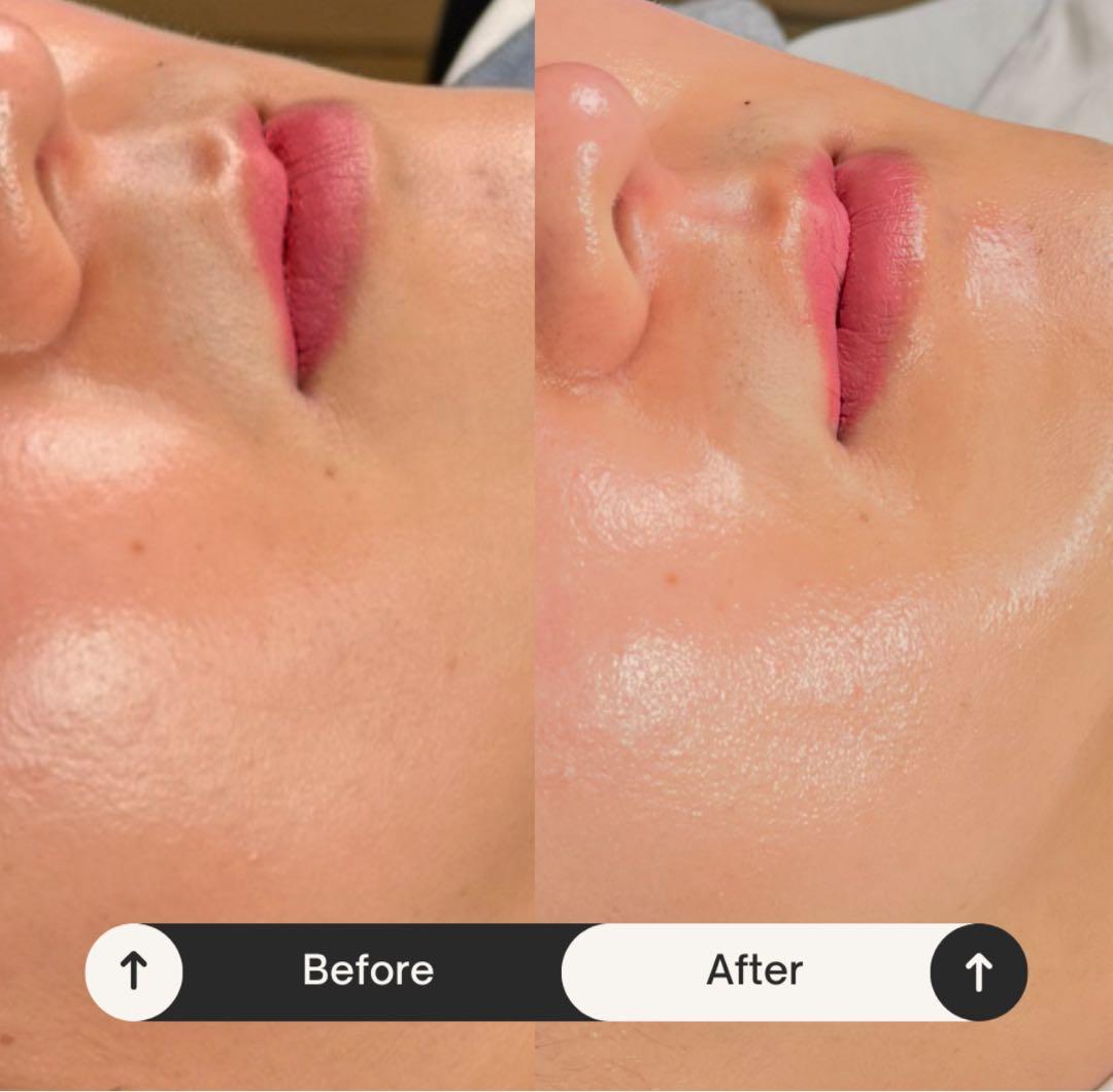 効果実証済　業務用美容機器LDM 水玉リフティング　超音波美肌マシン