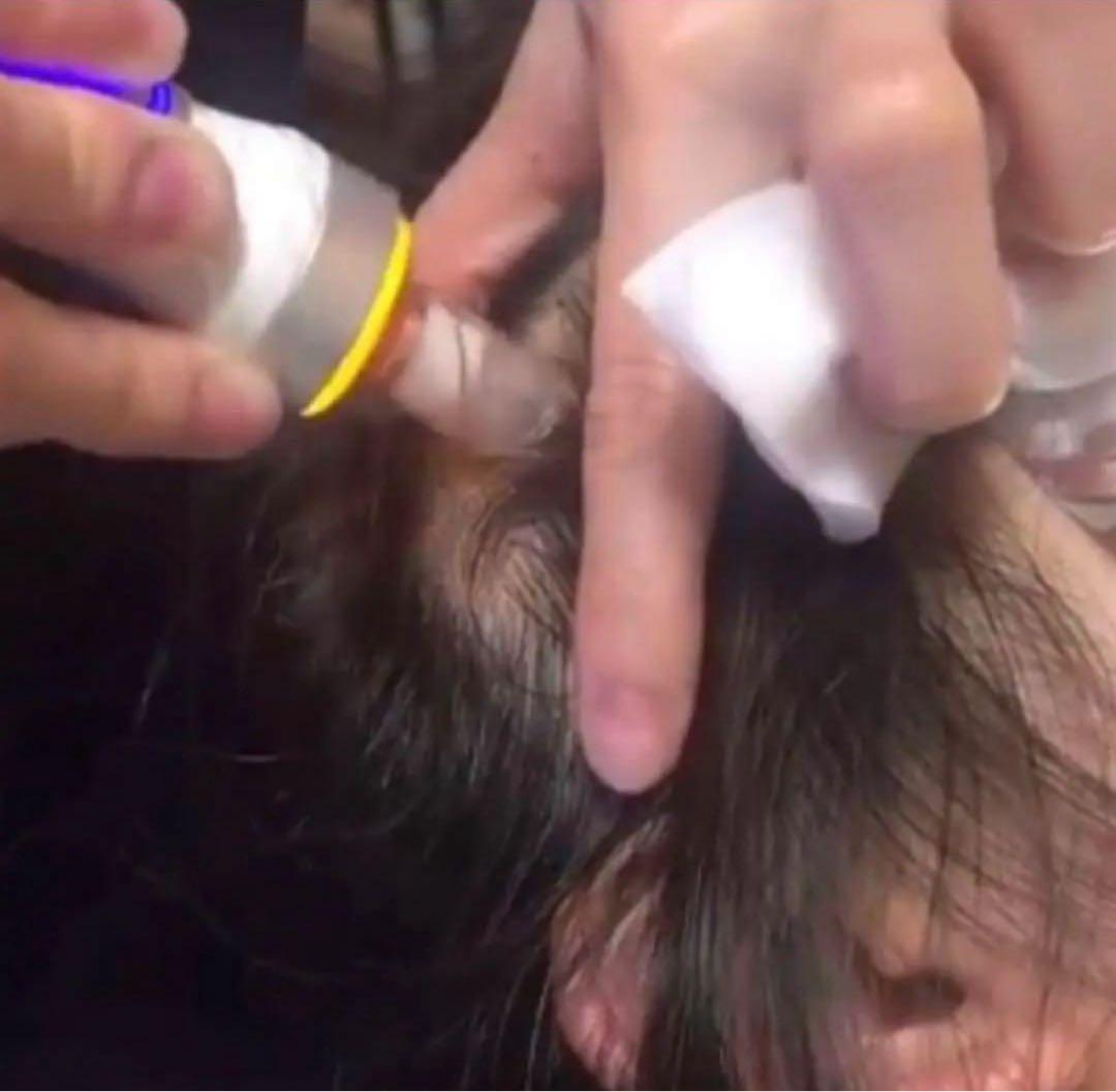 HydraFacial 水素洗浄　ハイドロインパクトプラス