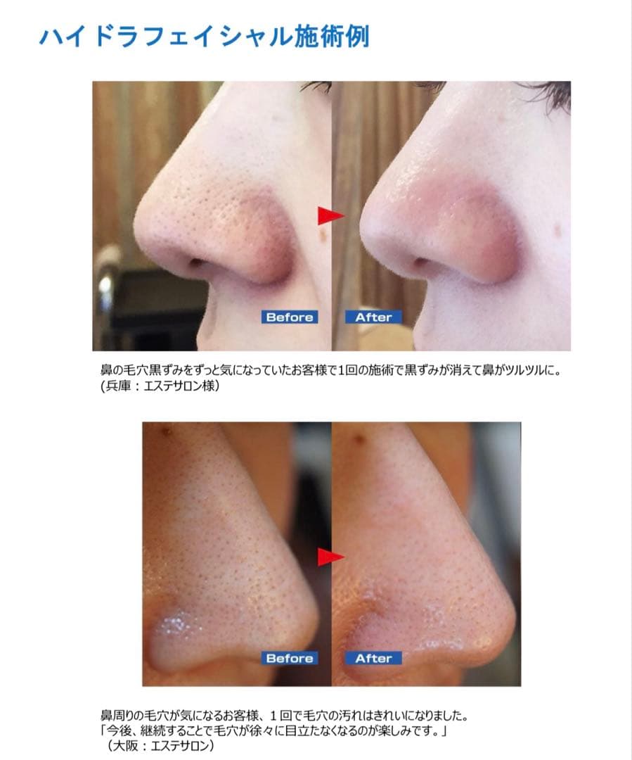 AQUA ELLA ハイドロフェイシャル　美容液ピーリング