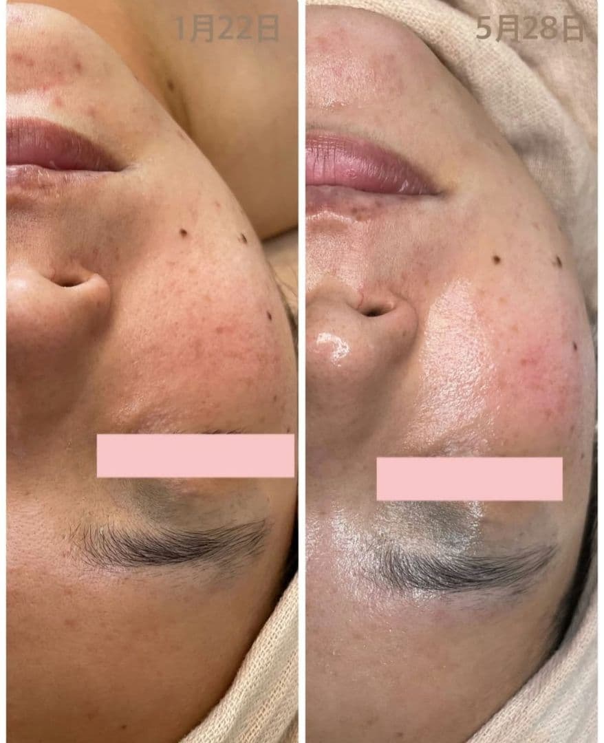 3時間限定価格！プラズマニードルカリファEX　美容液セット