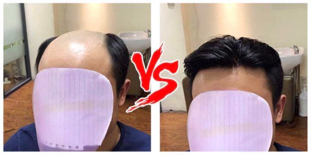 【自然な見た目！高品質メンズ部分カツラ】