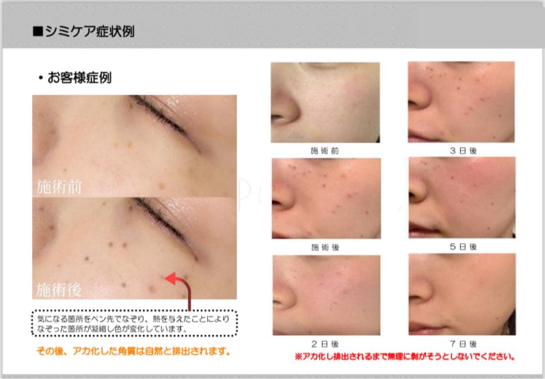 新品★送料無料★シミケア機器★タッチパネル式★簡単♪業務用・ホームケア使用可能★