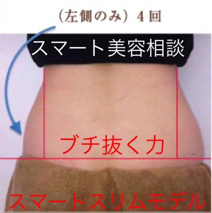 エステサロン痩身  業務用レベル　キャビテーション ラジオ波 5mhz