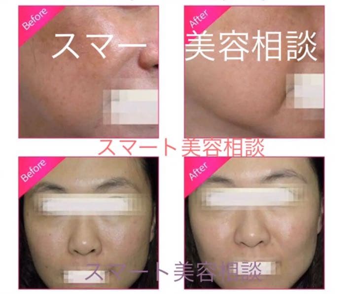 エステサロン痩身  業務用レベル　キャビテーション ラジオ波 5mhz