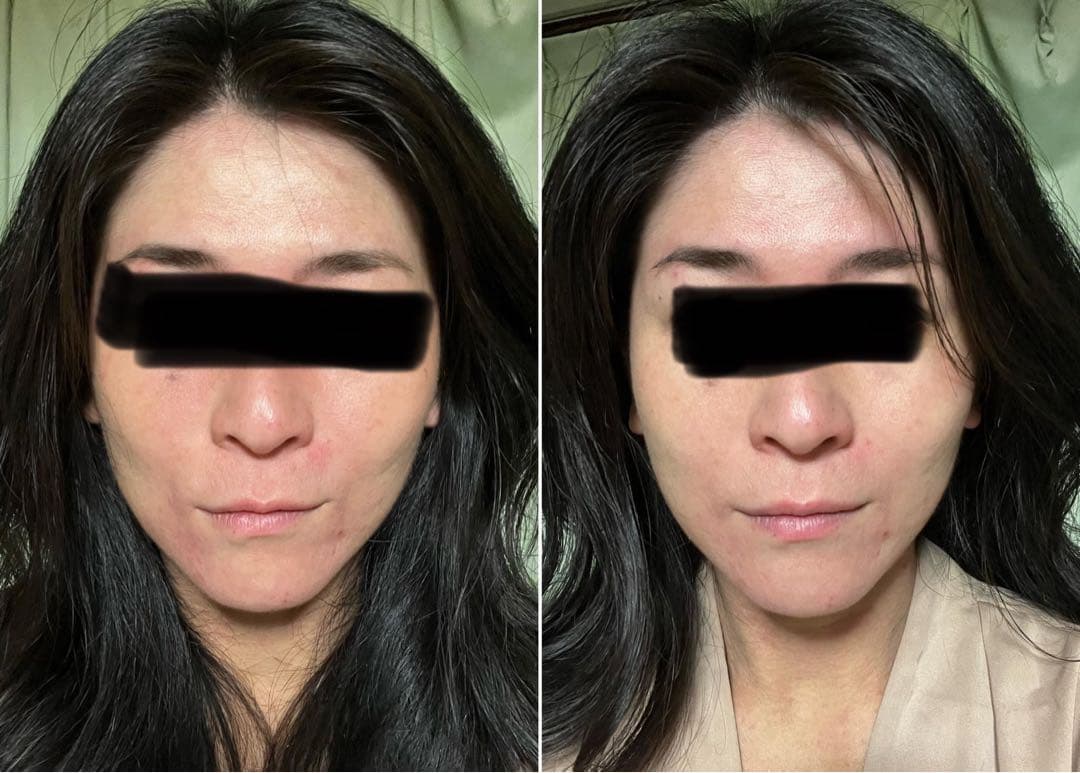 ふるえる美顔ローラー