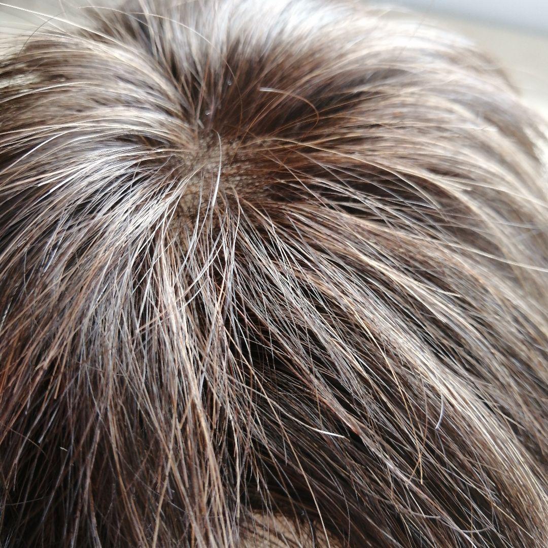 医療用スヴェンソンウィッグ人毛ミックス人工皮膚付きショートブラウン