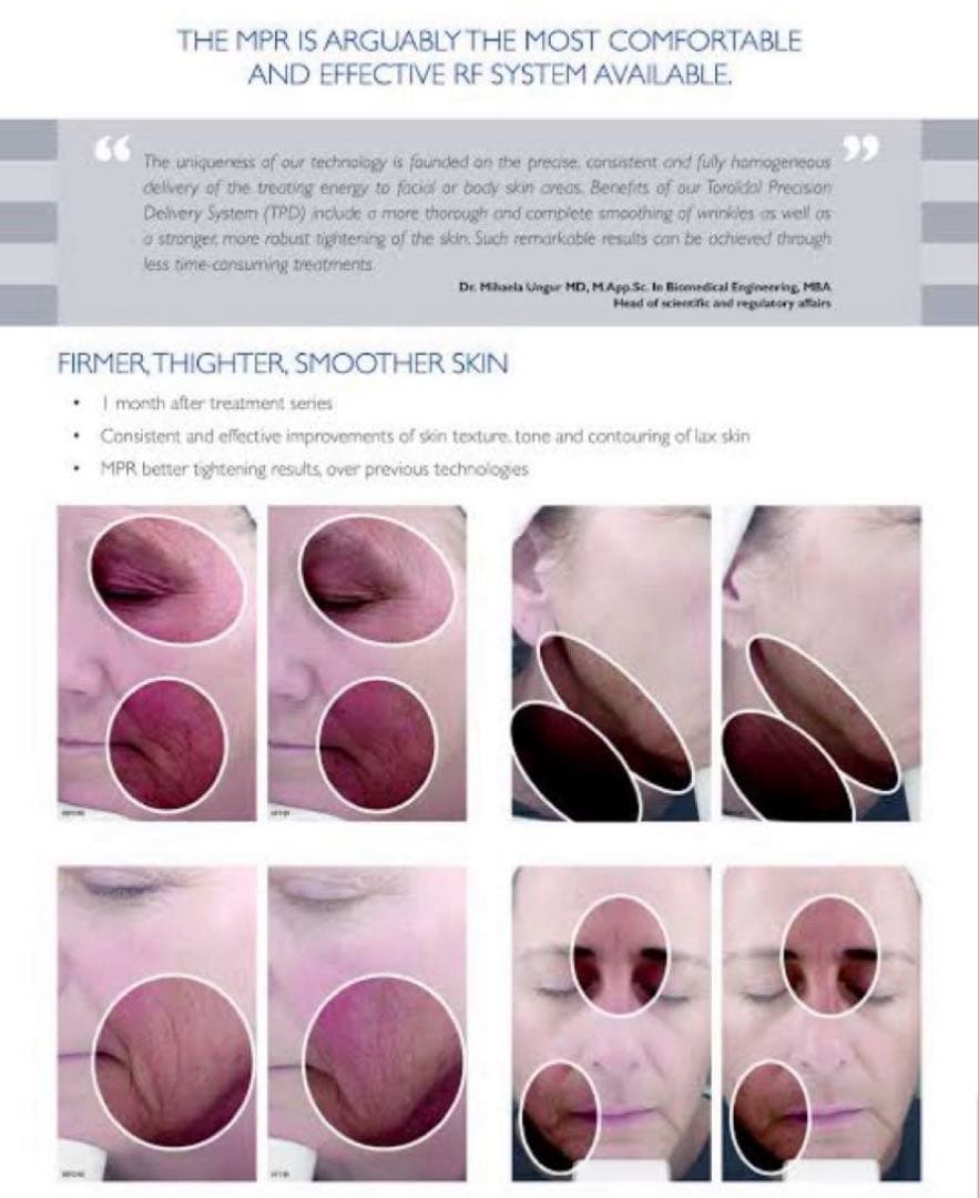 MPR トロイダル RF 業務用美容機器　美顔器　ダイエット　たるみ　しわ