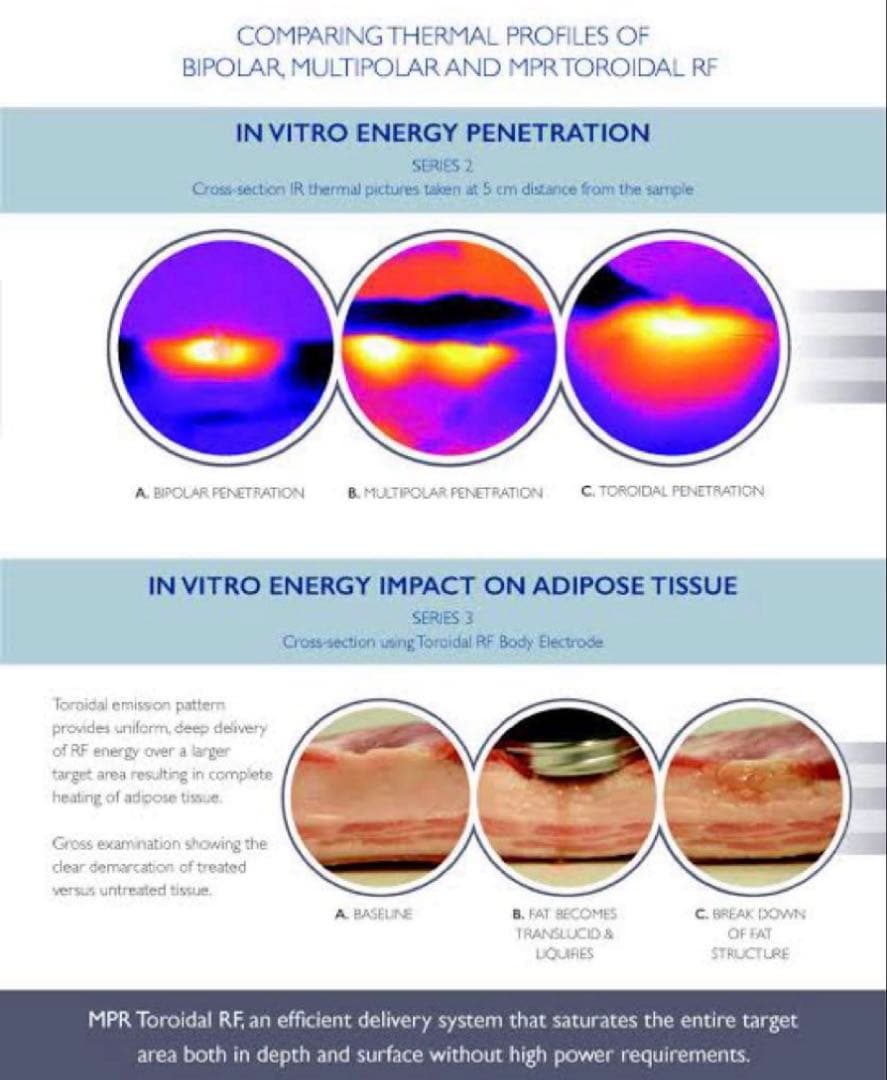 MPR トロイダル RF 業務用美容機器　美顔器　ダイエット　たるみ　しわ