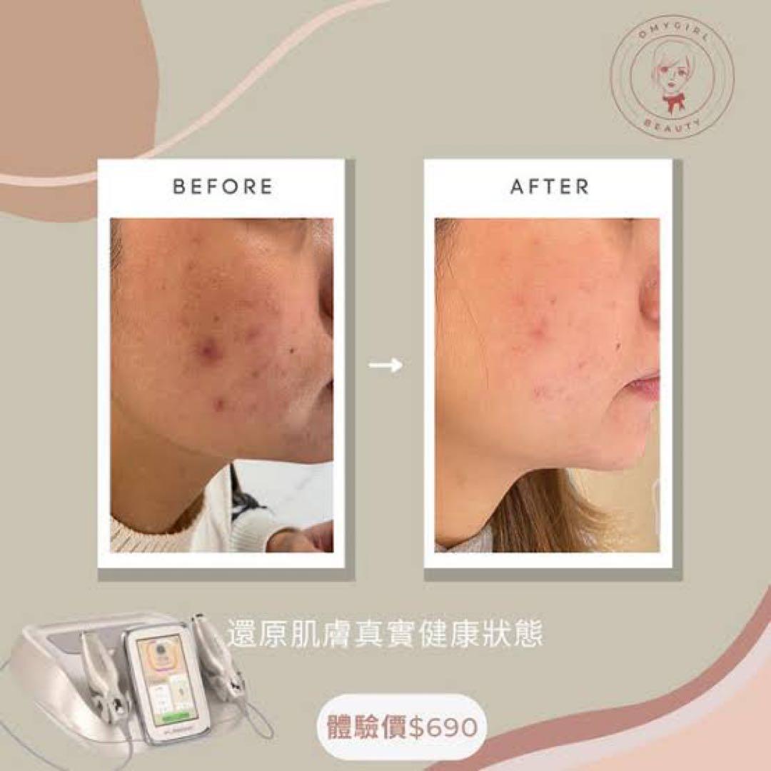 プラズマ plasma 美容　シミ　肝斑　ニキビ　LDM エレクトロポレーション