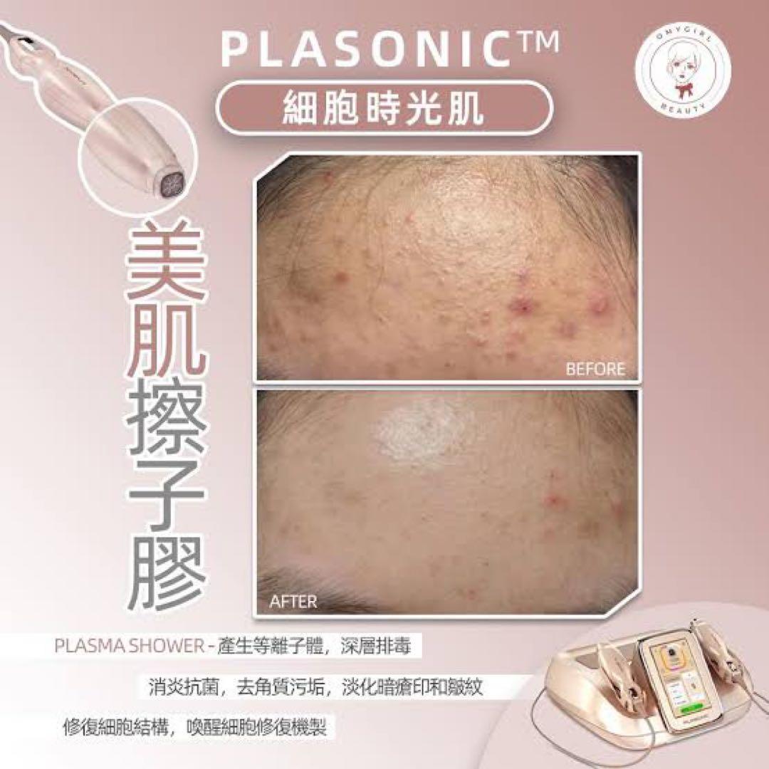 プラズマ plasma 美容　シミ　肝斑　ニキビ　LDM エレクトロポレーション