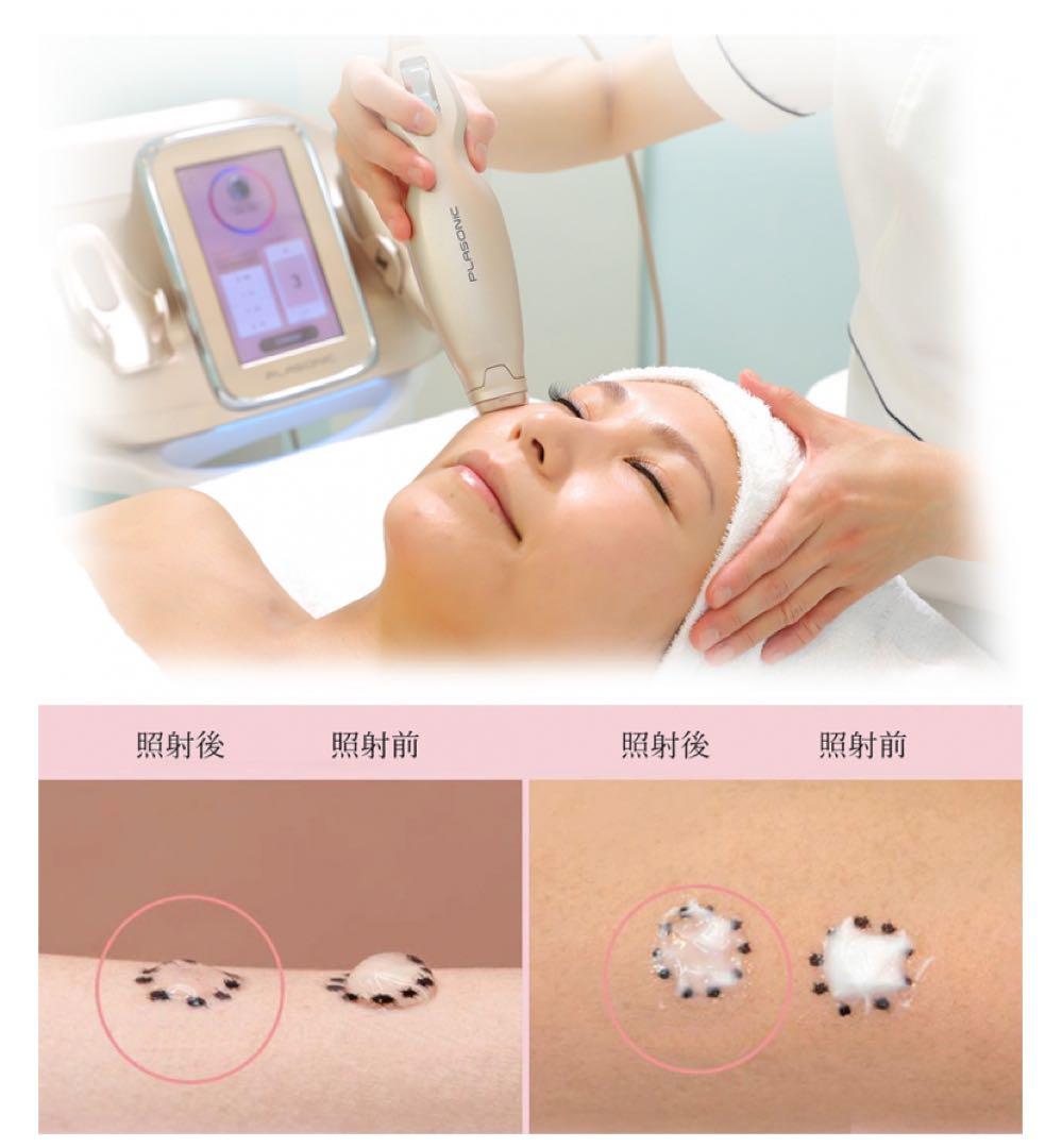 プラズマ plasma 美容　シミ　肝斑　ニキビ　LDM エレクトロポレーション