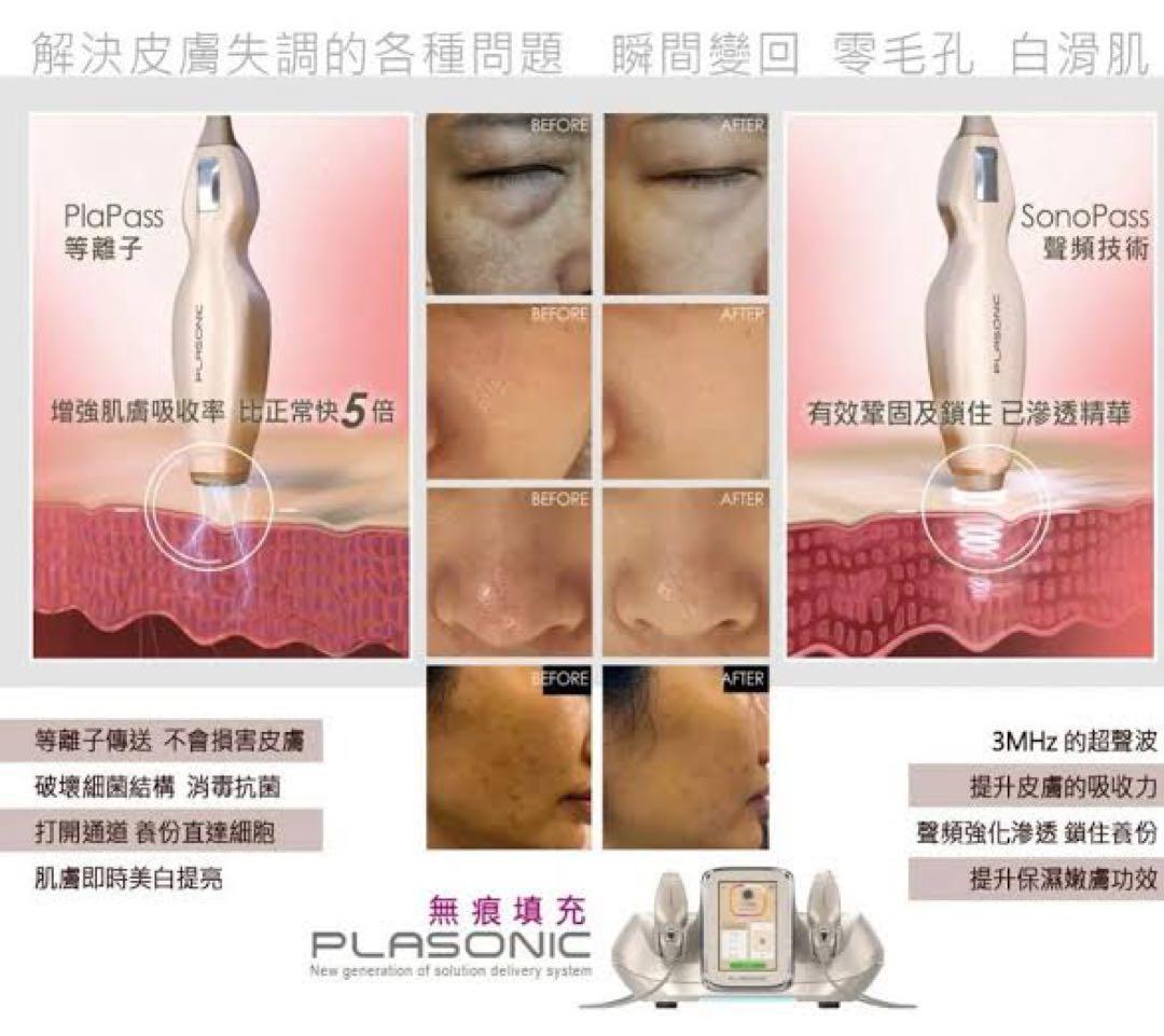 プラズマ plasma 美容　シミ　肝斑　ニキビ　LDM エレクトロポレーション