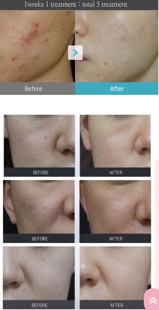 プラズマ plasma 美容　シミ　肝斑　ニキビ　LDM エレクトロポレーション