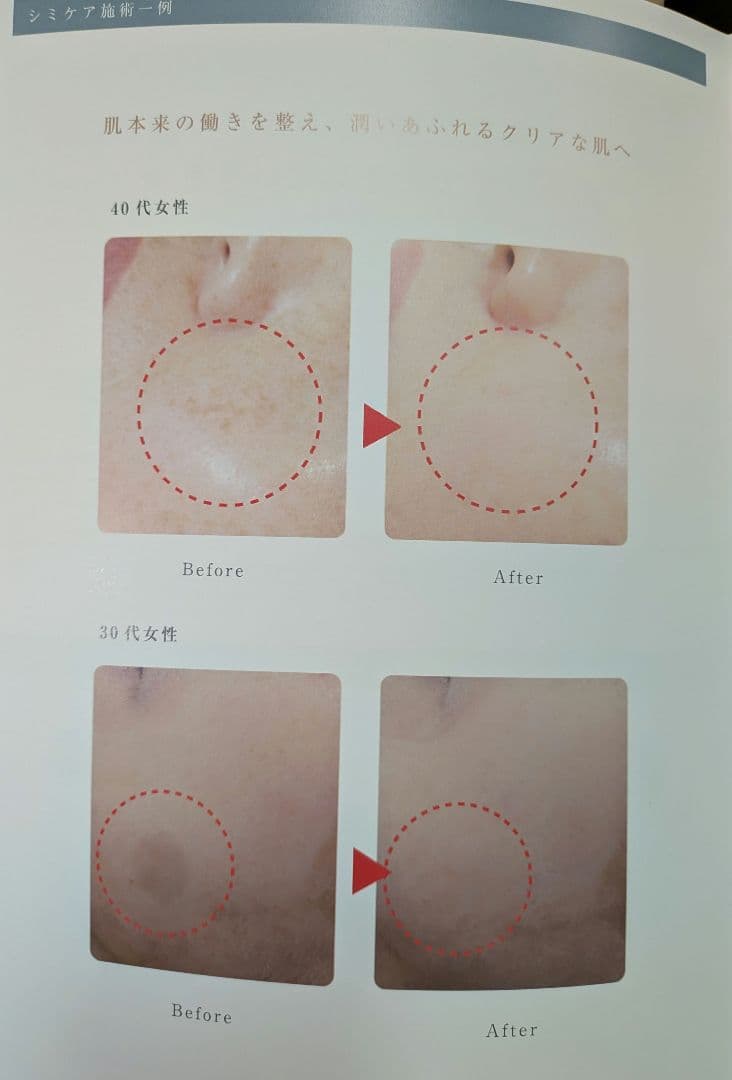 REAGE(リアージュ) 美顔器 シミ対策