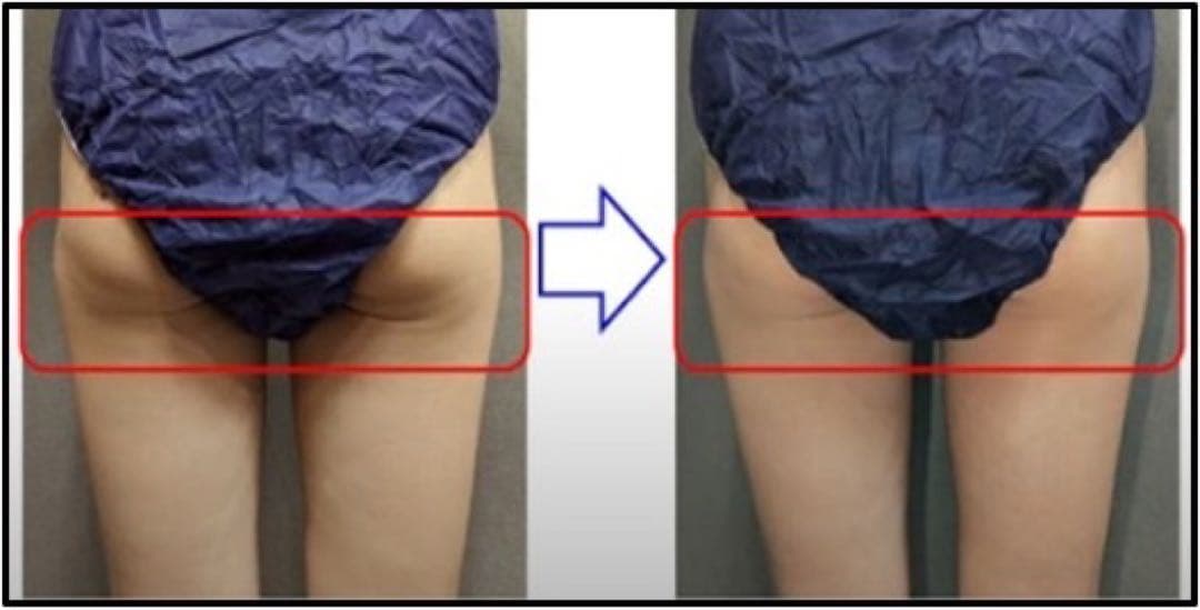 【最強痩身クリーム‼️】NFクリーム McCoy ノンFシリーズ /サロン専売品