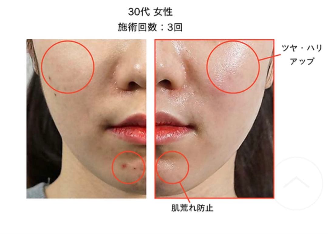 ★つむぎ　新ララピール　特別セット