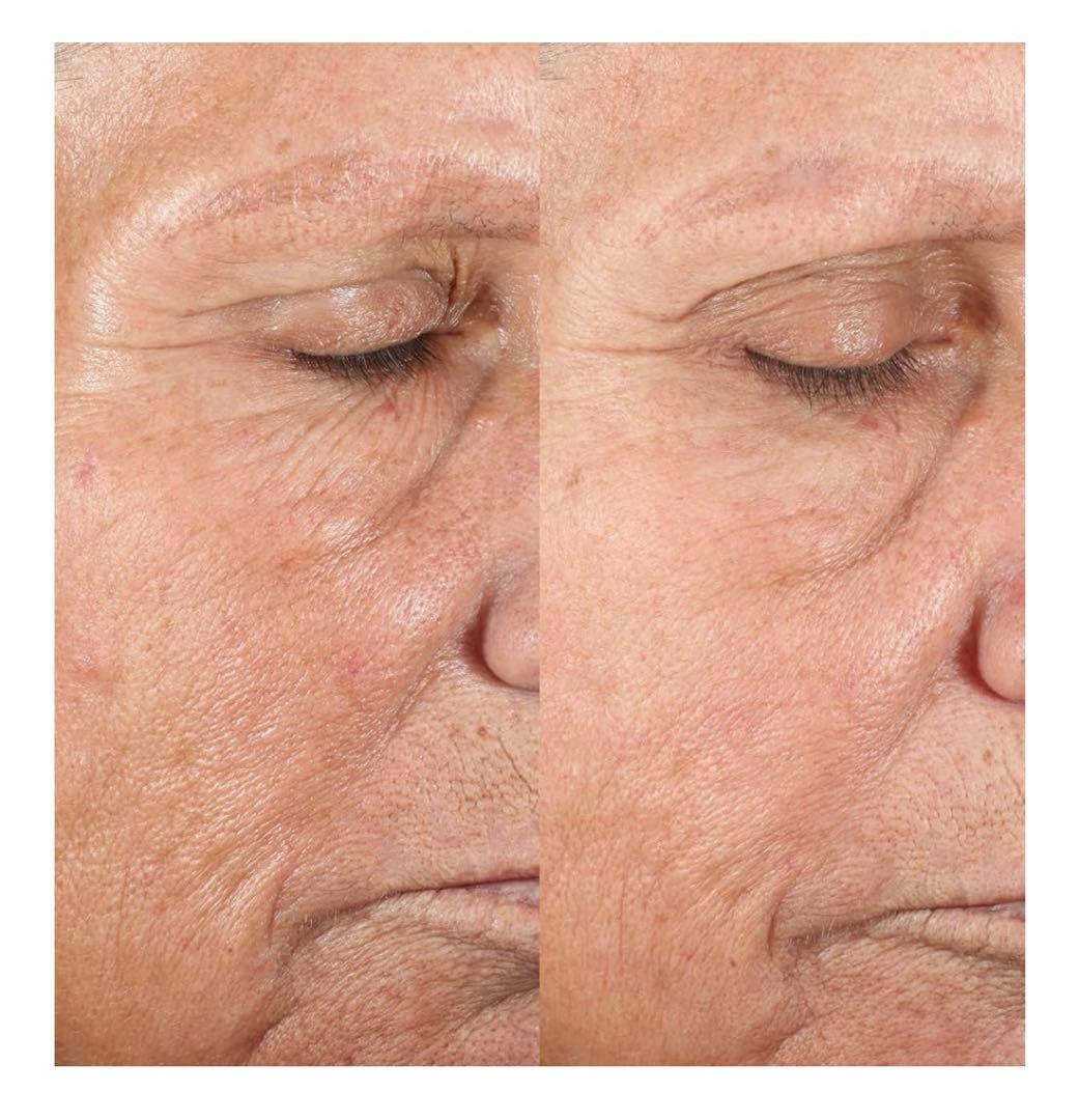 パーソナル・マイクロダーマ(PMD) 家庭用角質除去