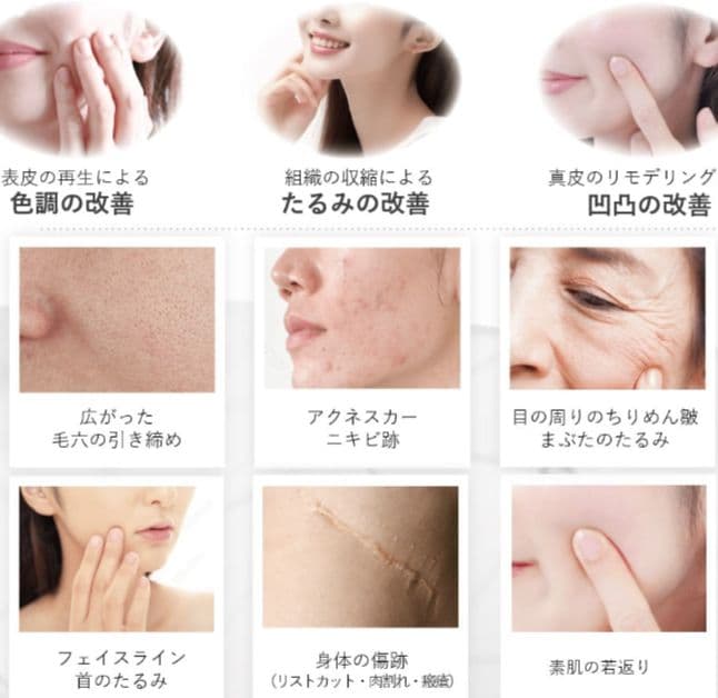 tria 美容 家庭用シミ取りレーザー　肝斑　ニキビ跡　色素沈着　毛穴開き　美白