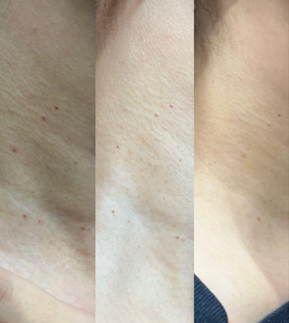 a*i様 プラズマ美容機