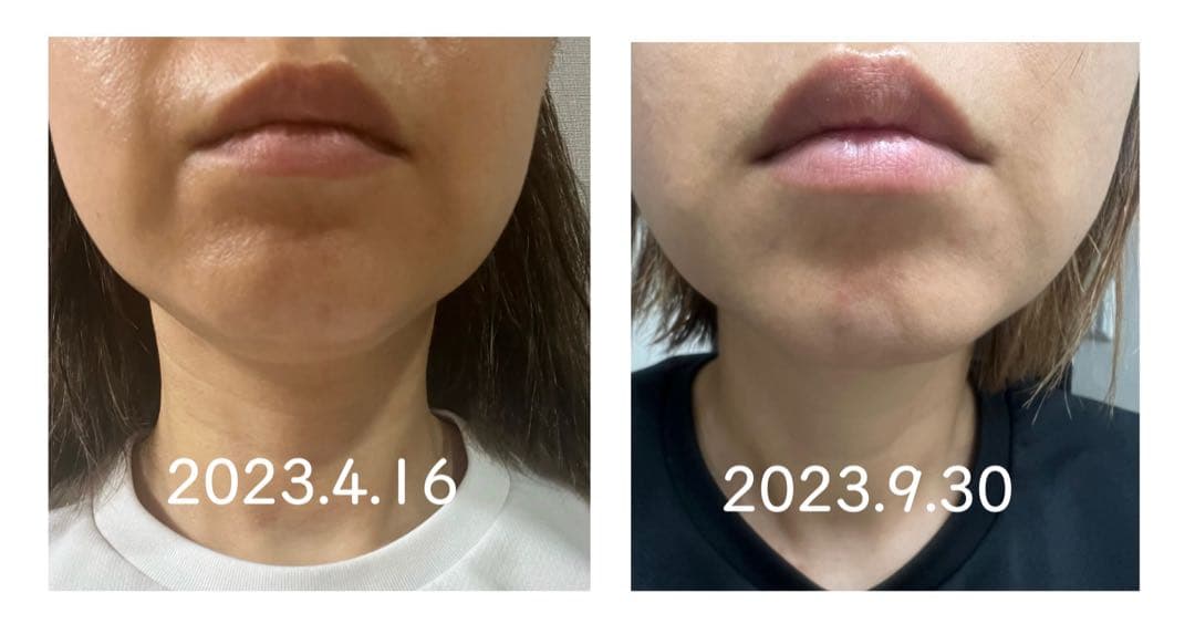 サロン使用✨新品未開封 エレクトロポレーション 美顔器 約30％OFF❗