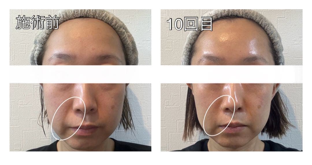 サロン使用✨新品未開封 エレクトロポレーション 美顔器 約30％OFF❗