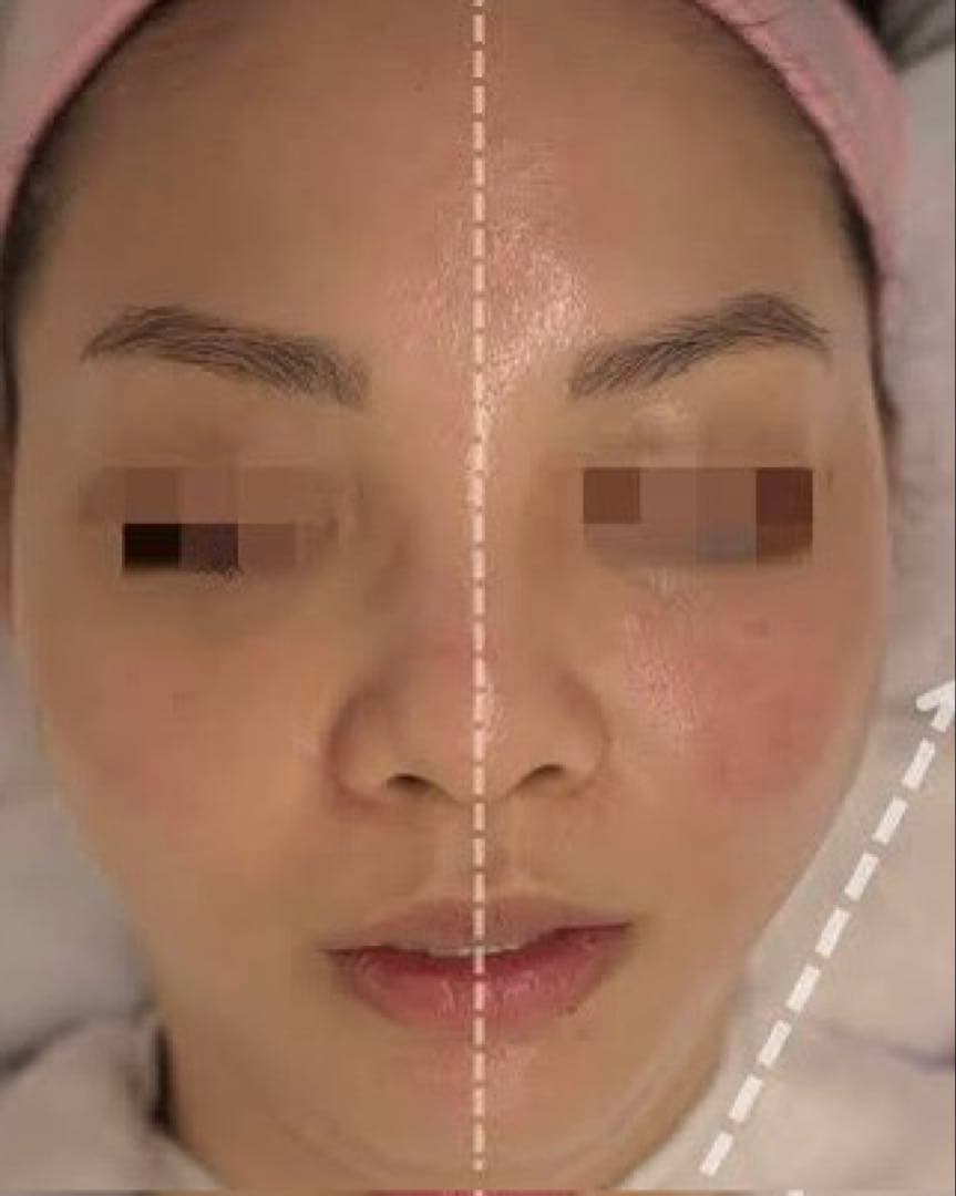 サーマル、美容機器、リフトアップ、