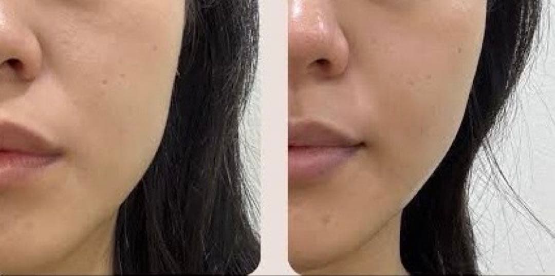 サーマル、美容機器、リフトアップ、