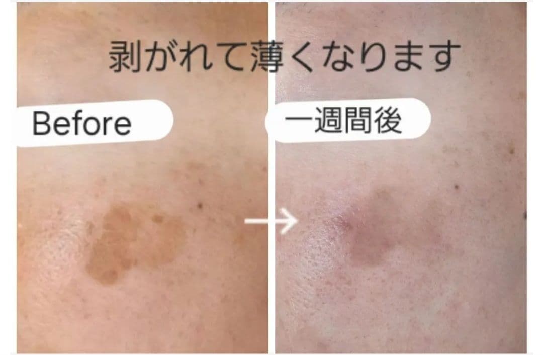 Pignet 美顔器■電気美容針/シミとり/導入