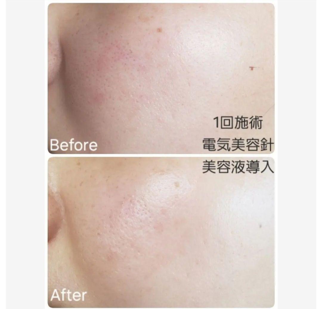 Pignet 美顔器■電気美容針/シミとり/導入