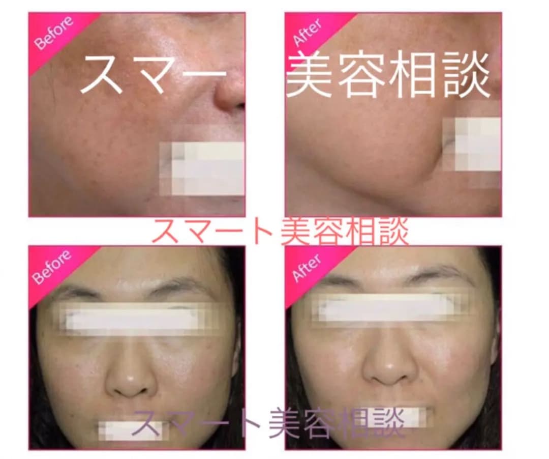 リフトアップ、RF、若返り、シワ 業務用、美容機器