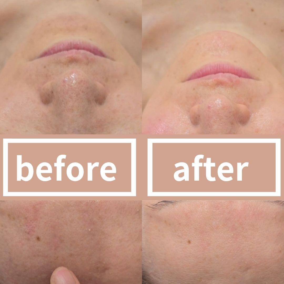 【最新版】ララピール+洗顔フォームセット