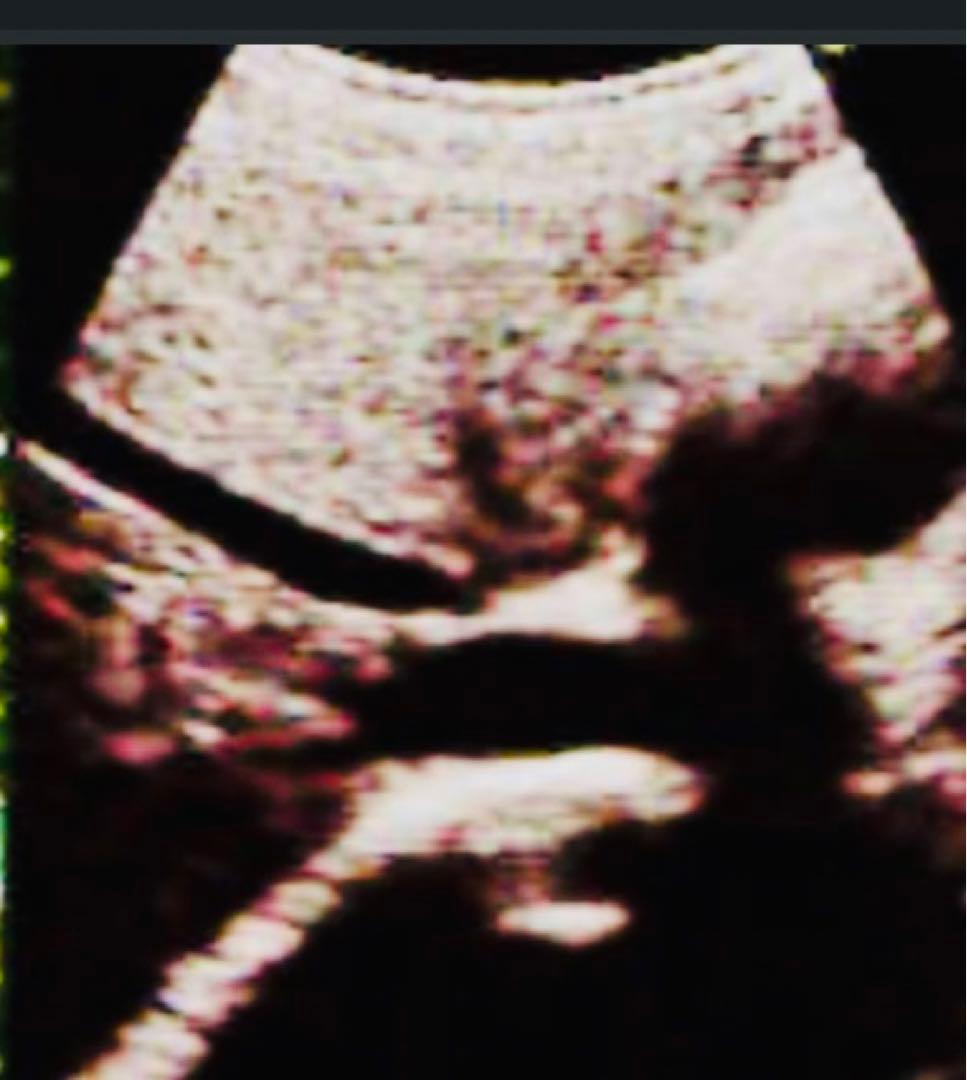 超音波検査装置（エコー）