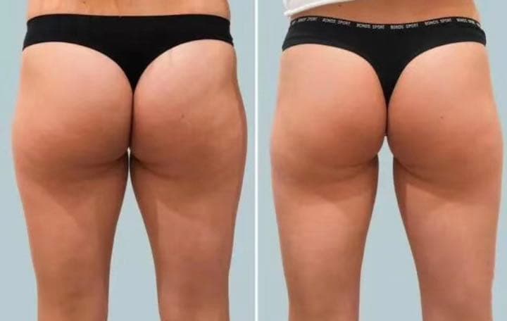 冷凍脂肪溶解 フリーズファット