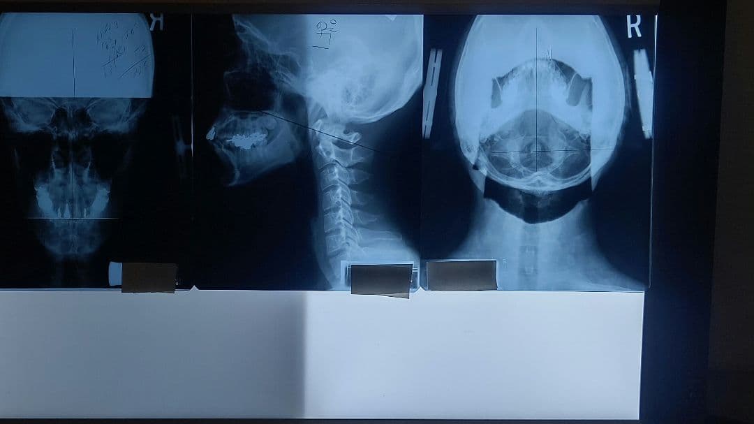 LED大型X線フィルムライトボックス